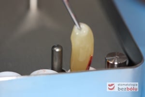 Umieszczenie skrzepu fibrynowego w kasecie prasującej