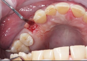 Odwarstwienie płata śluzówkowo-okostnowego