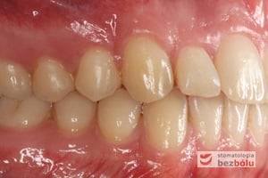 Zęby w zwarciu po leczeniu - strona prawa