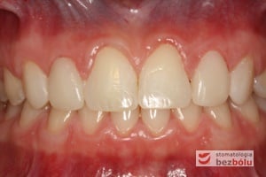 Okluzja po leczeniu ortodontyczno-protetycznym Okluzja po leczeniu ortodontyczno-protetycznym