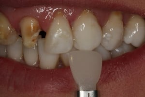 Wstępna przymiarka koloru pod przyszłą odbudowę protetyczną Wstępna przymiarka koloru pod przyszłą odbudowę protetyczną