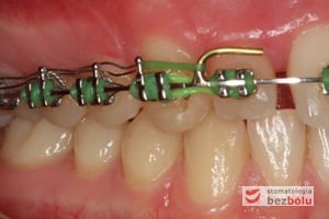 Strona prawa z łukiem typu posted