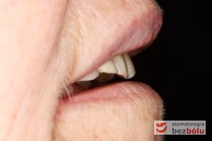 Ocena profilu wyłaniania siekaczy gónych - stopień wychylenia siekaczy górnych determinuje podparcie dla warg i policzków Ocena profilu wyłaniania siekaczy gónych - stopień wychylenia siekaczy górnych determinuje podparcie dla warg i policzków