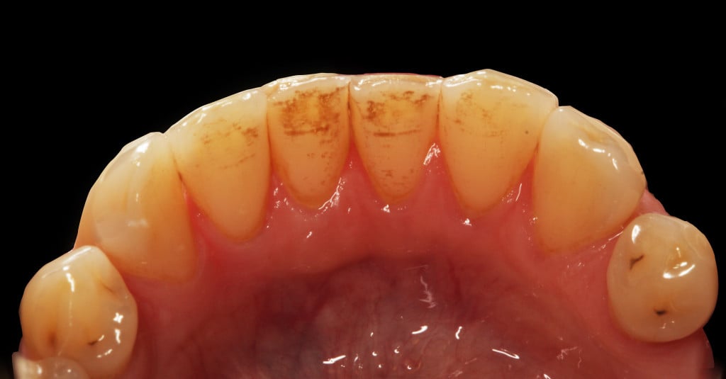 widok od strony językowej - widoczny osad