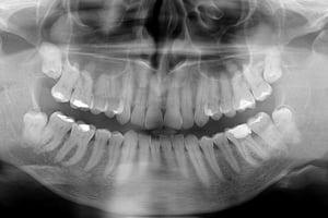 Zdjęcie pantomograficzne wykonane przed leczeniem - sięgnąć gdzie wzrok nie sięga