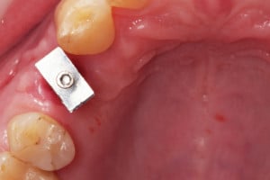 Transfer wyciskowy przykręcony do implantu