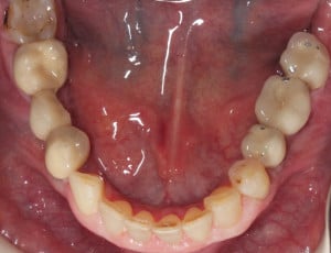 Przykręcona korona na implancie - widok od powierzchni okluzyjnej