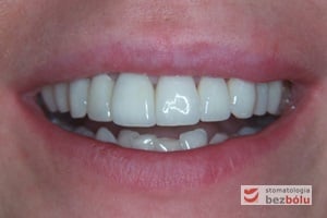 Pozytywna przemiana uśmiechu - ostateczny efekt