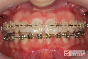 Aktywna faza leczenia z zastosowaniem odpowiedniej sekwencji łuków niti i stalowych