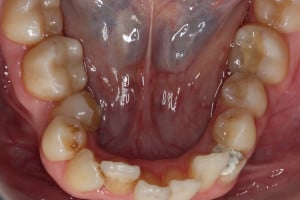 Kształt łuku dolnego przed leczeniem Kształt łuku dolnego przed leczeniem