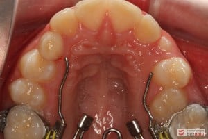 Zamontowany Rotator w szczęce Zamontowany Rotator w szczęce