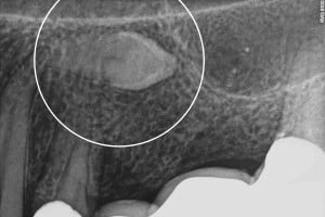 Ząb zatrzymany - warto wiedzieć Ząb zatrzymany - warto wiedzieć