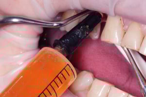 Płukanie łoża implantu osoczem