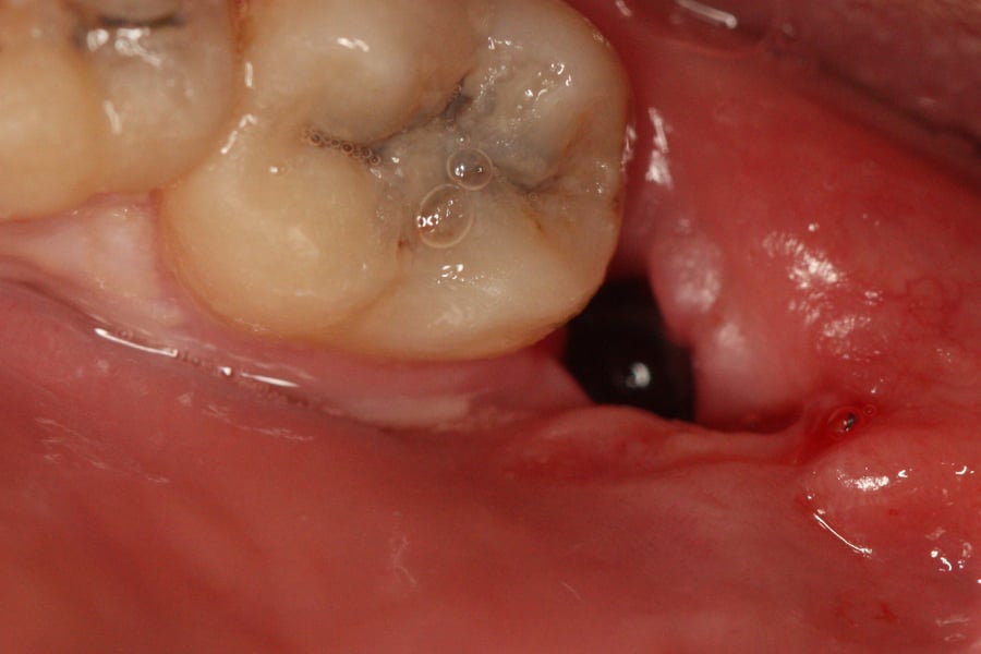 Suchy zębodół - warto wiedzieć Suchy zębodół - warto wiedzieć