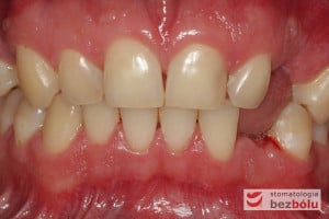 Uzębienie pacjenta - widok z przodu Uzębienie pacjenta - widok z przodu