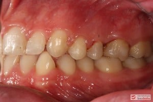 Warunki zgryzowe po leczeniu - strona lewa Warunki zgryzowe po leczeniu - strona lewa