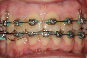 Wczesna faza leczenia w obu łukach Wczesna faza leczenia w obu łukach