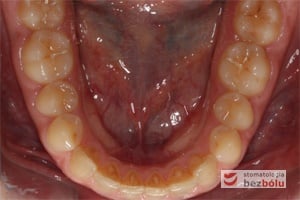 Widok łuku dolnego przed leczeniem - powierzchnia okluzyjna Widok łuku dolnego przed leczeniem - powierzchnia okluzyjna