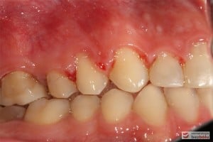 Warunki zgryzowe po leczeniu - strona prawa Warunki zgryzowe po leczeniu - strona prawa