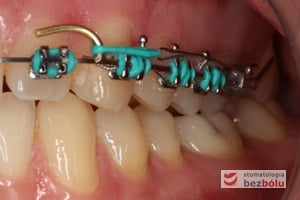 Strona lewa z łukiem typu posted