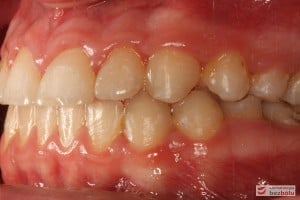 Warunki zgryzowe po leczeniu, strona lewa Warunki zgryzowe po leczeniu, strona lewa