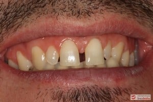 Uśmiech pacjenta przed leczeniem Uśmiech pacjenta przed leczeniem