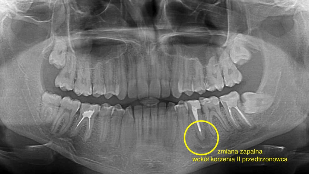 zmiana zapalna w drugim przedtrzonowcu w żuchwie po lewej stronie