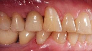Sytuacja wewnątrzustna po zakńczonym leczeniu - widok od strony policzkowej