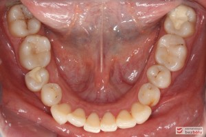 Wygląd łuku dolnego przed leczeniem Wygląd łuku dolnego przed leczeniem