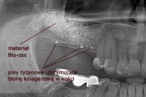Kontrolne zdjęcie radiologiczne po wykonanym zabiegu - widoczny materiał kościozastępczy Bio-oss Kontrolne zdjęcie radiologiczne po wykonanym zabiegu - widoczny materiał kościozastępczy Bio-oss