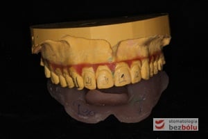 Model gipsowy podzielony przy pomocy wosku Model gipsowy podzielony przy pomocy wosku