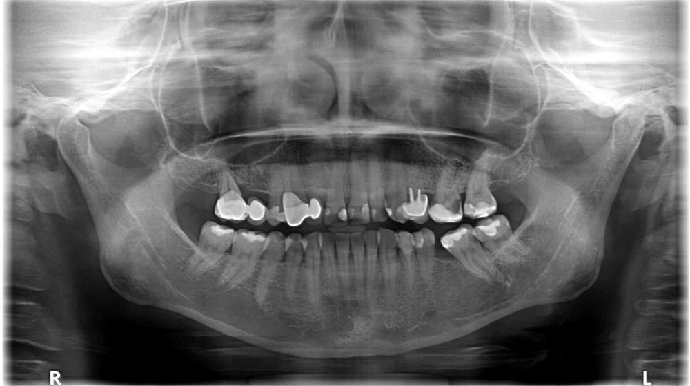 Leczenie kanałowe - diagnostyka OPG Leczenie kanałowe - diagnostyka OPG