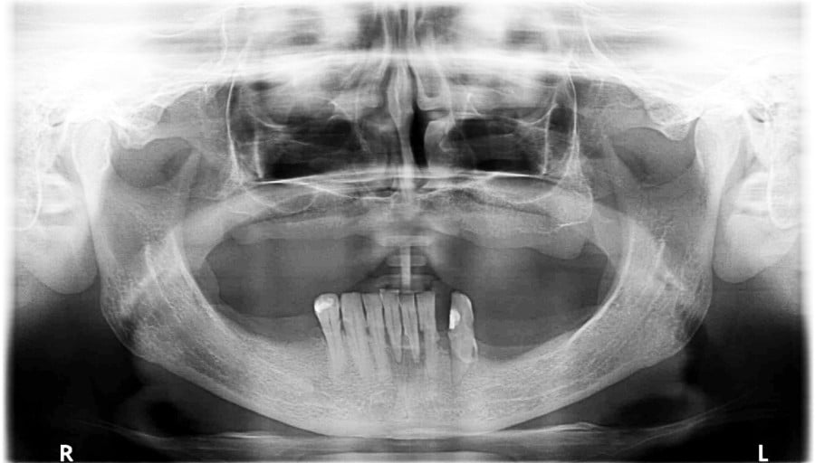 Zdjęcie pantomograficzne