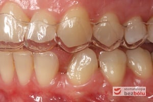 Pierwszy pozycjoner na zębach górnych - strona lewa Pierwszy pozycjoner na zębach górnych - strona lewa