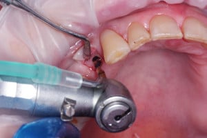 Preparacja łoża implantu