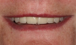 Pozytywna przemiana uśmiechu - protetyczny most porcelanowy na metalu w szczęce