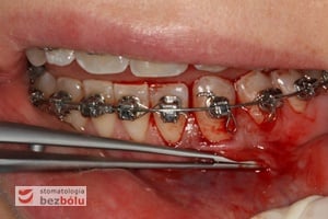 Ocena położenia linii śluzówkowo-dziąsłowej Ocena położenia linii śluzówkowo-dziąsłowej