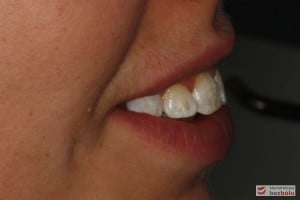 Nadmierne wychylenie zębów siecznych górnych Nadmierne wychylenie zębów siecznych górnych