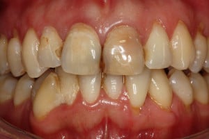 Stan wyjściowy - widok frontalny, dyskoloracje nieszczelne wypełnienia, martwy siekacz centralny Stan wyjściowy - widok frontalny, dyskoloracje nieszczelne wypełnienia, martwy siekacz centralny