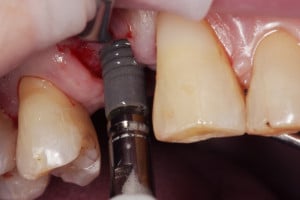 Wprowadzenie implantu