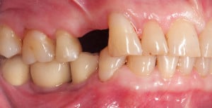 Sytuacja wewnątrzustna przed zabiegiem - strona lewa