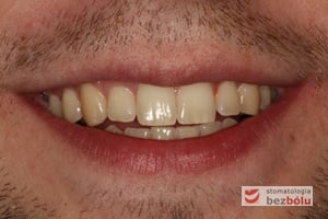 Uśmiech pacjenta po zakończonym leczeniu - rozdzielenie bliźniąt