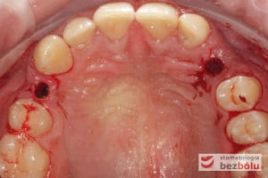 Wypreparowane łoża implantów