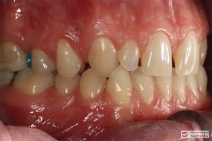 Warunki zgryzowe przed leczeniem - strona prawa Warunki zgryzowe przed leczeniem - strona prawa