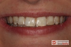 Uśmiech pacjentki zadowolonej z efektów leczenia - leczenie bezekstrakcyjne