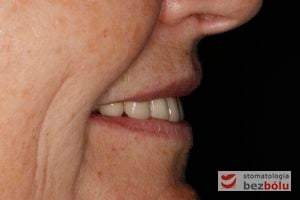 Ocena profilu wyłaniania koron definitywnych - podparcie wargi górnej zapewnia zmiana torku siekaczy górnych na bardziej protruzyjny Ocena profilu wyłaniania koron definitywnych - podparcie wargi górnej zapewnia zmiana torku siekaczy górnych na bardziej protruzyjny