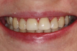 Uśmiech pacjentki po leczeniu Uśmiech pacjentki po leczeniu