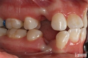 Warunki zgryzowe - strona prawa (widoczna dokonana ekstrakcja dolnej i górnej czwórki) Warunki zgryzowe - strona prawa (widoczna dokonana ekstrakcja dolnej i górnej czwórki)