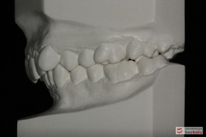 Warunki okluzyjne na modelach gipsowych przed leczeniem Warunki okluzyjne na modelach gipsowych przed leczeniem