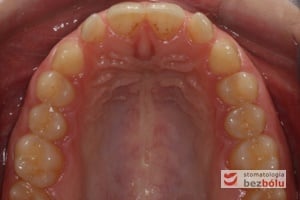 Widok łuku górnego przed leczeniem - powierzchnia okluzyjna Widok łuku górnego przed leczeniem - powierzchnia okluzyjna